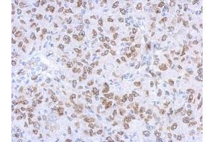 IHC-P Image Immunohistochemical analysis of paraffin-embedded Mahlarvu xenograft, using Lamin A + C, antibody at 1:500 dilution.