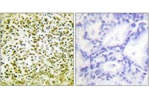 Immunohistochemistry analysis of paraffin-embedded human lung carcinoma tissue, using p53 (Ab-317) Antibody. (p53 anticorps  (AA 283-332))