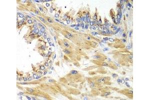Immunohistochemistry of paraffin-embedded Human prostate using PICK1 Polyclonal Antibody at dilution of 1:100 (40x lens). (PICK1 anticorps)