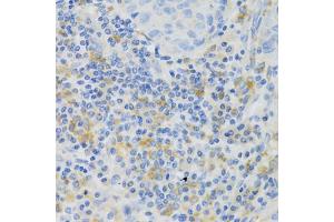 Immunohistochemistry of paraffin-embedded human lung cancer using PAK1 Antibody (ABIN5971674) at dilution of 1/100 (40x lens). (PAK1 anticorps)