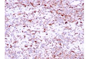 Formalin-fixed, paraffin-embedded human Liver Carcinoma stained with Cathepsin K Mouse Monoclonal Antibody (CTSK/2791). (Cathepsin K anticorps  (AA 163-274))