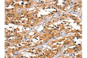 The image on the left is immunohistochemistry of paraffin-embedded Human thyroid cancer tissue using ABIN7189781(ALOX15 Antibody) at dilution 1/60, on the right is treated with synthetic peptide. (ALOX15 anticorps)