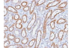 Formalin-fixed, paraffin-embedded human Renal Cell Carcinoma stained with CD61 Rabbit Recombinant Monoclonal Antibody (ITGB3/2166R).