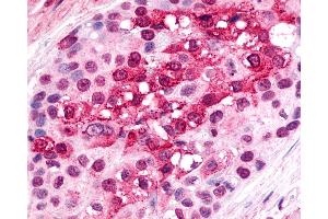 Anti-CXCR6 antibody IHC of human Breast, Carcinoma. (CXCR6 anticorps  (Cytoplasmic Domain))