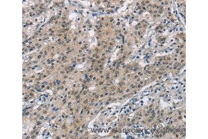 Immunohistochemistry of Human gastric cancer using SMAD9 Polyclonal Antibody at dilution of 1:30 (SMAD9 anticorps)