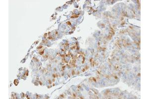 IHC-P Image Immunohistochemical analysis of paraffin-embedded GSTA2 xenograft, using GSTO1, antibody at 1:100 dilution.