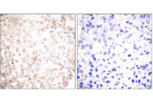 Immunohistochemistry analysis of paraffin-embedded human lung carcinoma tissue using XRCC1 antibody. (XRCC1 anticorps  (C-Term))