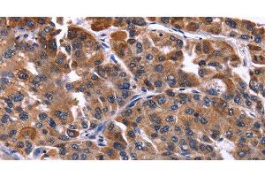 Immunohistochemistry of paraffin-embedded Human liver cancer tissue using NFATC3 Polyclonal Antibody at dilution 1:50