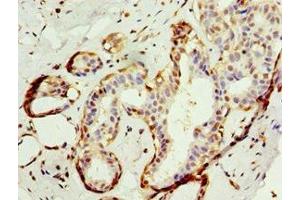 Immunohistochemistry of paraffin-embedded human breast cancer using ABIN7144041 at dilution of 1:100