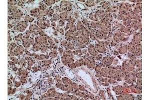 Immunohistochemistry (IHC) analysis of paraffin-embedded Human Pancreas Cancer, antibody was diluted at 1:100. (SERPINA3 anticorps  (Internal Region))