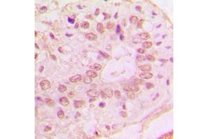 Immunohistochemical analysis of p15 INK4b staining in human lung cancer formalin fixed paraffin embedded tissue section.