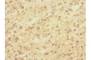 Immunohistochemistry of paraffin-embedded human glioma using ABIN7148481 at dilution of 1:100 (CNTNAP1 anticorps  (AA 20-300))