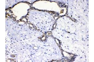 IHC testing of FFPE human breast cancer tissue with SCF antibody at 1ug/ml.