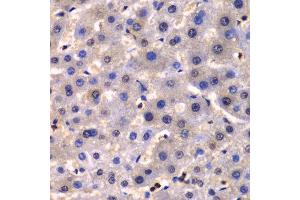 Immunohistochemistry of paraffin-embedded human liver cancer using IKBKG antibody at dilution of 1:100 (400x lens).
