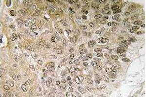 Immunohistochemistry (IHC) analyzes of PI 3-kinase p85alpha antibody in paraffin-embedded human lung carcinoma tissue. (PIK3R1 anticorps)