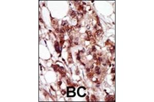 Formalin-fixed and paraffin-embedded human cancer tissue reacted with the primary antibody, which was peroxidase-conjugated to the secondary antibody, followed by AEC staining. (BRD4 anticorps  (C-Term))