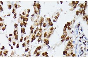 Immunohistochemistry of paraffin-embedded Human lung cancer using HNRNPD Polyclonal Antibody at dilution of 1:100 (40x lens). (HNRNPD/AUF1 anticorps)