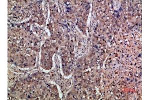 Immunohistochemical analysis of paraffin-embedded human-lung-cancer, antibody was diluted at 1:200 (IFNAR1 anticorps  (AA 300-350))