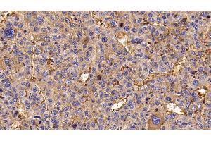 Detection of EGFR in Human Liver cancer Tissue using Monoclonal Antibody to Epidermal Growth Factor Receptor (EGFR) (EGFR anticorps  (AA 888-1210))