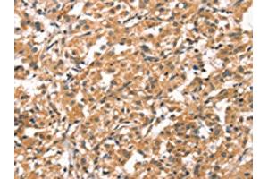 The image on the left is immunohistochemistry of paraffin-embedded Human thyroid cancer tissue using ABIN7190421(CYP46A1 Antibody) at dilution 1/15, on the right is treated with synthetic peptide. (CYP46A1 anticorps)