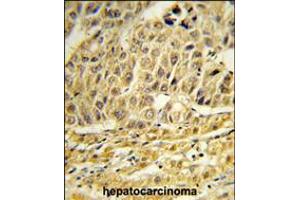 Formalin-fixed and paraffin-embedded human hepatocarcinoma reacted with CCNB1IP1 Antibody , which was peroxidase-conjugated to the secondary antibody, followed by DAB staining. (CCNB1IP1 anticorps  (C-Term))