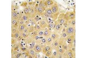IHC analysis of FFPE human hepatocarcinoma tissue stained with Connective Tissue Growth Factor antibody