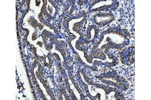 IHC analysis of TRK fused gene/TFG using anti-TRK fused gene/TFG antibody (ABIN7599839). (TFG anticorps  (AA 121-400))