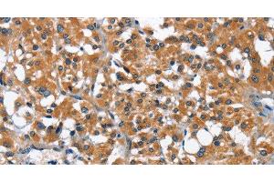 Immunohistochemistry of paraffin-embedded Human thyroid cancer using ARMCX2 Polyclonal Antibody at dilution of 1:40 (ARMCX2 anticorps)