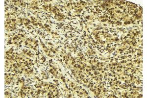 ABIN6272898 at 1/100 staining Human breast cancer tissue by IHC-P. (CRBN anticorps)