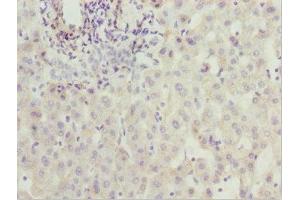 Immunohistochemistry of paraffin-embedded human liver cancer using ABIN7176529 at dilution of 1:100 (ZNF785 anticorps  (AA 1-200))