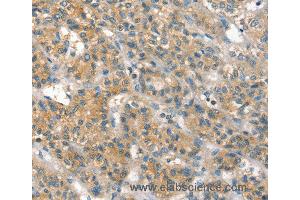 Immunohistochemistry of Human liver cancer using PPP2CA Polyclonal Antibody at dilution of 1:35 (PPP2CA anticorps)