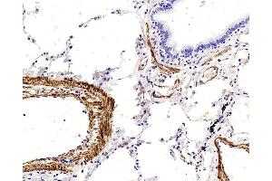 Immunohistochemistry analysis of paraffin-embedded human lung cancer using TAGLN Polyclonal Antibody at dilution of 1:400.