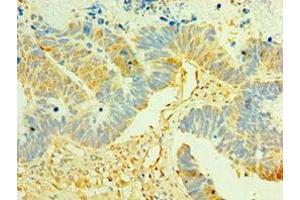 Immunohistochemistry of paraffin-embedded human ovarian cancer using ABIN7158358 at dilution of 1:100 (LIMK2 anticorps  (AA 1-240))