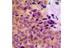 Immunohistochemical analysis of MMP8 staining in human breast cancer formalin fixed paraffin embedded tissue section.