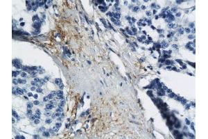 Formalin-fixed and paraffin embedded human breast cancer labeled with Anti MT-ND6 Polyclonal Antibody, Unconjugated  followed by conjugation to the secondary antibody and DAB staining (MT-ND6 anticorps  (AA 51-150))