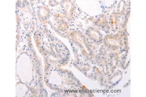 Immunohistochemistry of Human thyroid cancer using S1PR3 Polyclonal Antibody at dilution of 1:30 (S1PR3 anticorps)