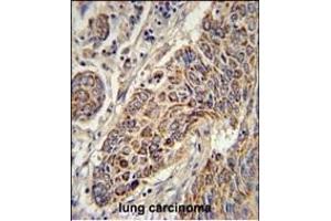 CYC1 Antibody (C-term) (ABIN651531 and ABIN2840281) immunohistochemistry analysis in formalin fixed and paraffin embedded human lung carcinoma followed by peroxidase conjugation of the secondary antibody and DAB staining. (Cytochrome C1 anticorps  (C-Term))