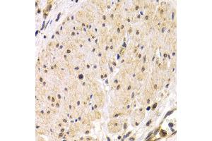 Immunohistochemistry of paraffin-embedded human stomach cancer using TMPRSS2 antibody at dilution of 1:200 (400x lens).