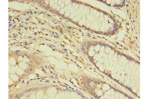 Immunohistochemistry of paraffin-embedded human colon cancer using ABIN7172148 at dilution of 1:100 (THRA anticorps  (AA 1-490))