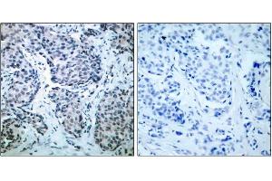 Immunohistochemical analysis of paraffin-embedded human breast carcinoma tissue, using SEK1/MKK4(phospho-Thr261)antibody (E011176). (MAP2K4 anticorps  (pThr261))