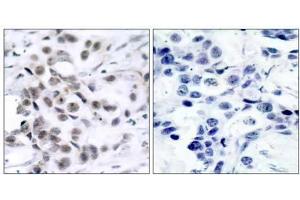 Immunohistochemical analysis of paraffin-embedded human breast carcinoma tissue using Chk1 (Ab-317) antibody (E021114). (CHEK1 anticorps)