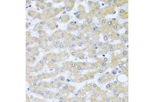 Immunohistochemistry of paraffin-embedded human liver injury using BCKDK antibody at dilution of 1:100 (x40 lens). (BCKDK anticorps)