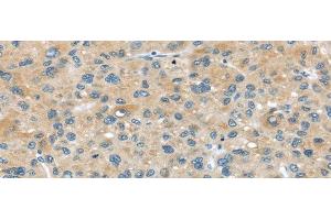 Immunohistochemistry of paraffin-embedded Human liver cancer tissue using ABCC2 Polyclonal Antibody at dilution 1:45 (ABCC2 anticorps)