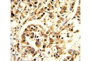 IHC analysis of FFPE human breast carcinoma stained with IL-12 antibody (IL12 anticorps  (AA 168-195))