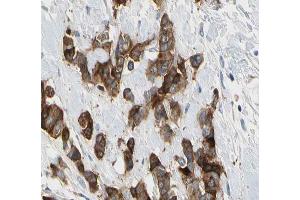 ABIN6266575 at 1/200 staining human breast carcinoma tissue sections by IHC-P. (Cytokeratin 7 anticorps  (C-Term))