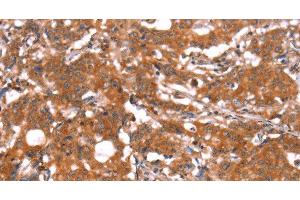 Immunohistochemistry of paraffin-embedded Human gastric cancer using FUT1 Polyclonal Antibody at dilution of 1:30 (FUT1 anticorps)