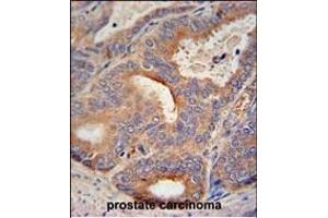 GLB1L2 antibody (C-term) (ABIN654822 and ABIN2844495) immunohistochemistry analysis in formalin fixed and paraffin embedded human prostate carcinoma followed by peroxidase conjugation of the secondary antibody and DAB staining. (GLB1L2 anticorps  (C-Term))