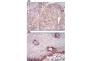 Immunohistochemical staining of human ovarian cancer tissues (A) and esophageal tissues (B) with FTL monoclonal antibody, clone 6E10E4  at 1:200-1:1000 dilution.