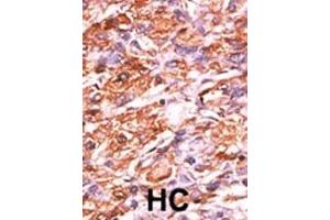 Formalin-fixed and paraffin-embedded human cancer tissue reacted with the primary antibody, which was peroxidase-conjugated to the secondary antibody, followed by AEC staining.