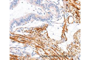 Immunohistochemistry of Human colon cancer using ARAP1 Polyclonal Antibody at dilution of 1:80 (ARAP1 anticorps)